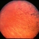 Retinitis Pigmentosa
